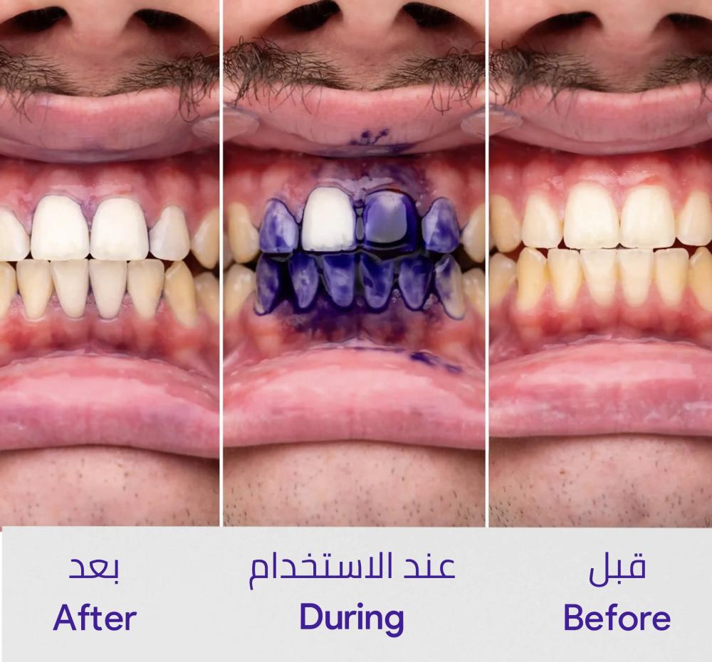 معجون اسنان هاي سمايل V34، معجون اسنان ارجواني لتبييض الاسنان